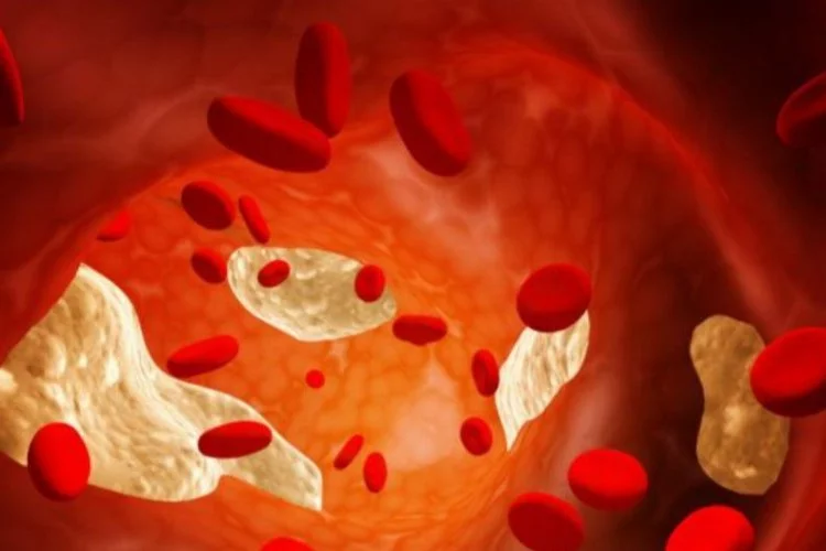 Hiperkolesterolemi nedir, belirtileri nelerdir?