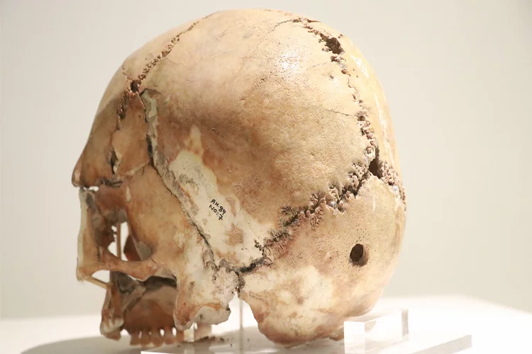 Dünyanın ilk beyin ameliyatına ait kafatası…10 bin 500 yıl önce Aksaray'da yapıldı
